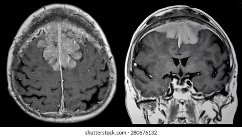 Brain Tumor, MRI