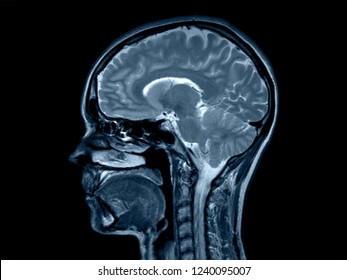 Brain X-ray Ct Head Vertebrae Spine Cord Incision