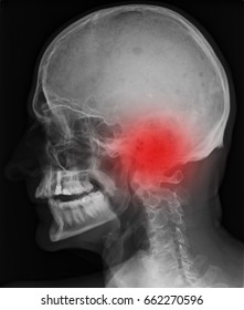 brainstem x-ray