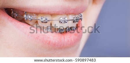 brasket system in smiling mouth, macro photo teeth, close-up lips, macro shot, dentist.