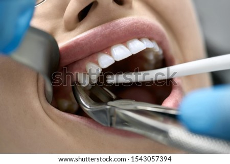 Brave girl in a dental clinic. Dentist in blue latex gloves is removing her tooth with a help of a cheek retractor and forceps. Closeup horizontal photo.