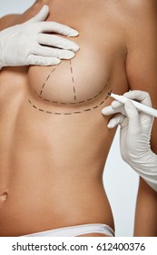 Breast Augmentation. Closeup Beautician Hands In Gloves Drawing Surgical Lines On Beautiful Woman Breast. Sexy Female Body With Black Marks On Breasts Before Plastic Surgery Operation. High Resolution