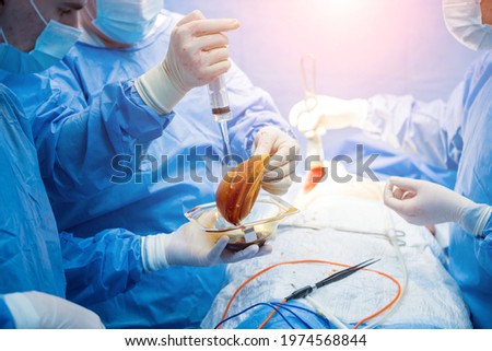 Breast augmentation under the guidance surgeons team in surgical operating room.