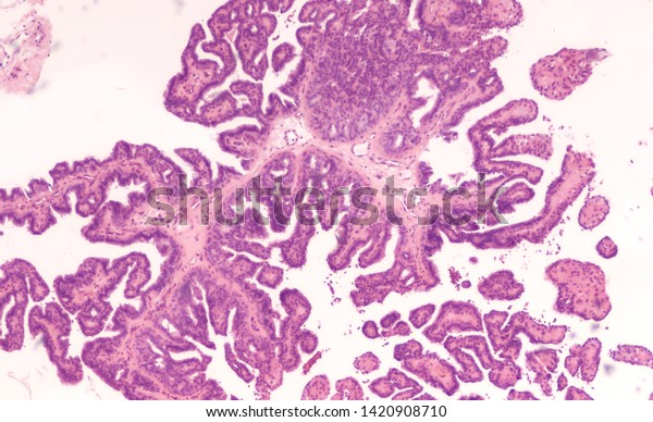 Breast Biopsy: Microscopic image (photomicrograph) of an\
intraductal papilloma, a benign tumor of the mammary lactiferous\
ducts (milk ducts).  It is typically treated by surgical excision. \
