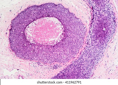 Breast Cancer Awareness, Ductal Carcinoma In Situ (DCIS): Tumor Cells Are Confined To The Mammary Ducts.  No Invasion Is Seen (photographed And Uploaded By US Board Certified Surgical Pathologist).