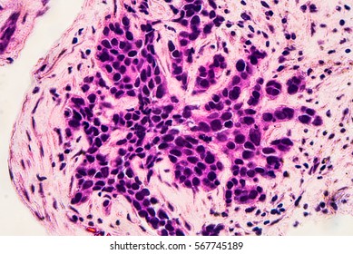 Breast Cancer Awareness: Microscopic image (photomicrograph) of core biopsy for infiltrating (invasive) ductal carcinoma, detected by screening mammogram. H & E stain. 