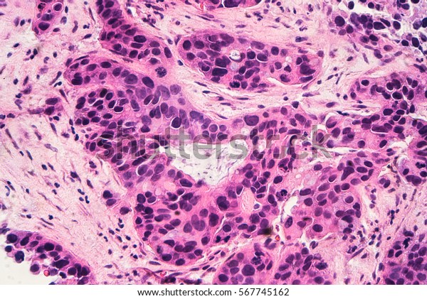 Breast Cancer Awareness Microscopic Image Photomicrograph Stock Photo 