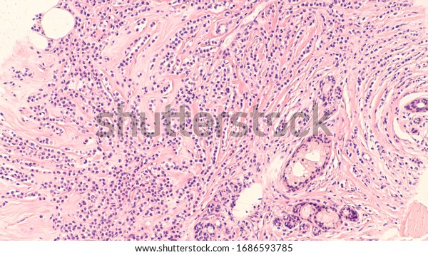 Breast cancer histology\
(biopsy): Microscopic image (photomicrograph) of an infiltrating\
(invasive) lobular carcinoma, detected by screening mammogram. H\
& E stain.