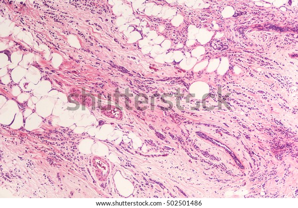 Breast cancer histology\
(biopsy): Microscopic image (photomicrograph) of an infiltrating\
(invasive) lobular carcinoma, detected by screening mammogram. H\
& E stain. 