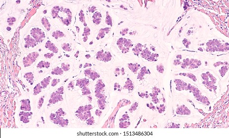 Breast cancer histology (core biopsy): Microscopic image (photomicrograph) of mucinous carcinoma, wth clusters of tumor cells floating in a sea of mucin.  Detected by screening mammogram. H & E stain.