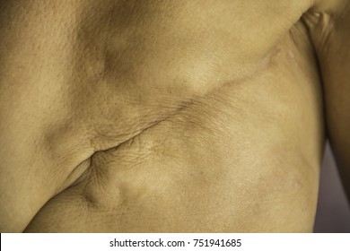 Breast Cancer Scar After Operation/surgery/vivisection On Breast Of Women.selective Focus.