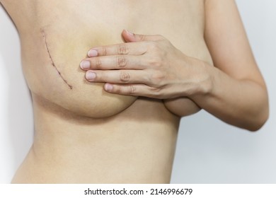 Breast Cancer Surgery Scars By Partial Mastectomy