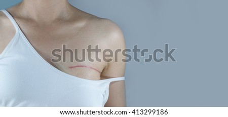 Breast cancer surgery scars by partial mastectomy.  She can wear a tube top or tube dress and strapless with confident. With effect filter and copy space.