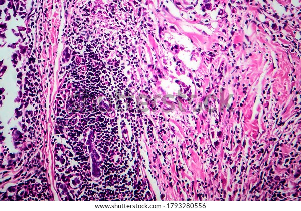 Breast Ductal Carcinoma Light Micrograph Photo Stock Photo 1793280556 