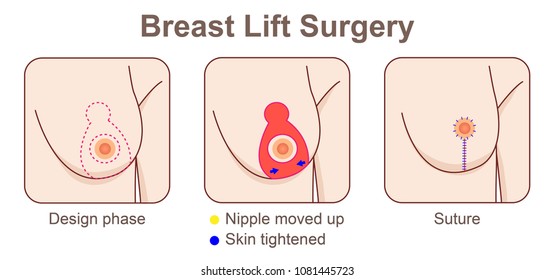 Breast Lift surgery