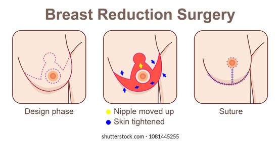 Breast reduction surgery