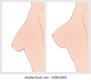 Breast Uplift before and after treatment.