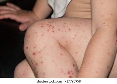 Bright rash with maculopapular lesions on skin of toddler infected with Hand, Foot and Mouth Disease caused by a strain of Coxsackie virus, a type of enterovirus from the Picornaviridae family.