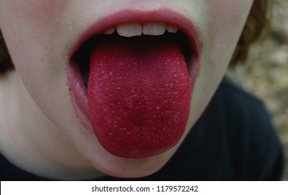 Bright Red Tongue - Strawberry Tongue