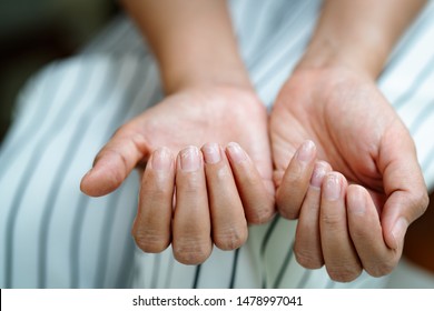 Brittle Damaged Nails After Using Shellac Or Gel-lacquer