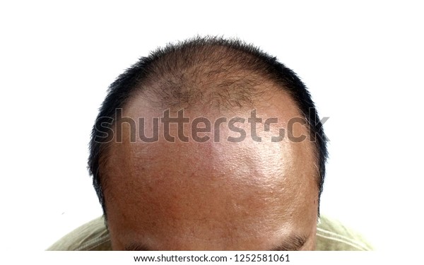 Broad Forehead Balding Thinning Hair Royalty Free Stock Image