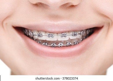 Broad Smile Girl With Metal Braces. Closeup