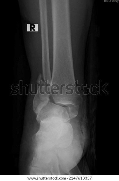 A broken\
ankle is a fracture or multiple fractures of one or more of three\
bones in the ankle joint: the tibia (shinbone), the fibula (outer\
bone of the lower leg), and the\
talus.