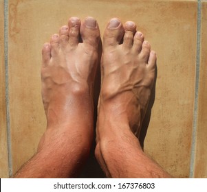 Broken Ankle, Mens Feet