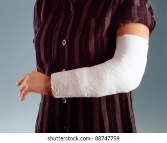 Broken Arm In Cast