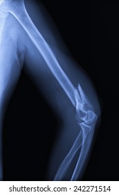 2,861 Elbow xray Images, Stock Photos & Vectors | Shutterstock