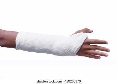 Broken Arm With A Plaster Cast Isolated On White