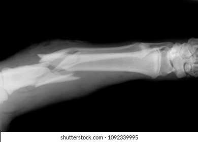 Broken Bone X-Ray 