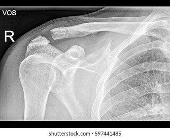 Broken Clavicle Bone Fixation, Fracture Repair