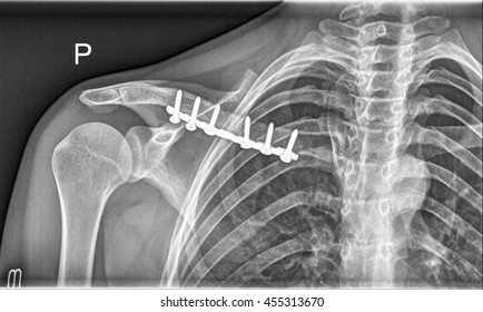 Broken Clavicle Bone, Shoulder Medical Xray