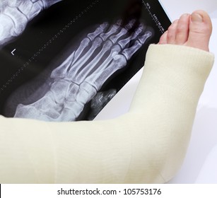 Broken Foot In A Cast With Xray Of Broken Foot Behind