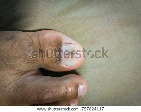 Broken foot nails