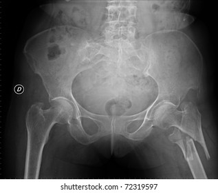 Broken Hip Of A Woman