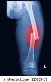 Broken Human Thigh X-rays Image ,Left Leg Fracture