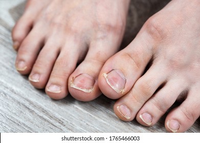 Broken And Ingrown Ugly Toenails Of A Sloppy Girl