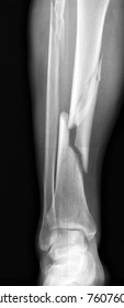 Broken leg / Many others X-ray images in my portfolio.