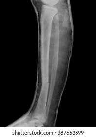 Broken Leg Plaster Cast Xray Image Stock Photo 387653899 | Shutterstock