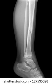 Broken Leg X-rays Image Showing Plate And Screw Fixation Tibia And Fibula Bone