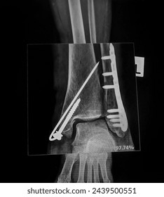 Broken leg x-rays image showing plate and screw fixation tibia and fibula bone