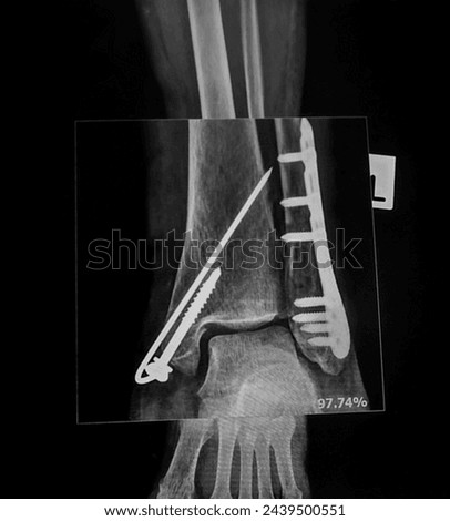 Broken leg x-rays image showing plate and screw fixation tibia and fibula bone