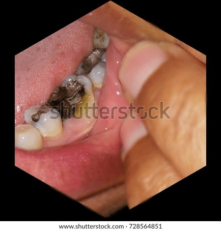 Broken molar