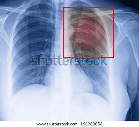 broken ribs