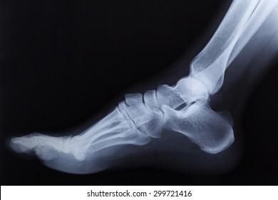 Broken Right Foot Ankle Xray, Side View