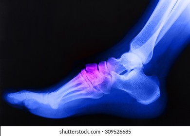 Broken Right Foot Ankle Xray, Side View