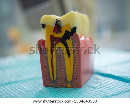 Broken / sick teeth model, caries-damaged tooth, sick tooth nerve, pulpitis disease, dentine-damaged, toothache in teeth, dentistry lesson