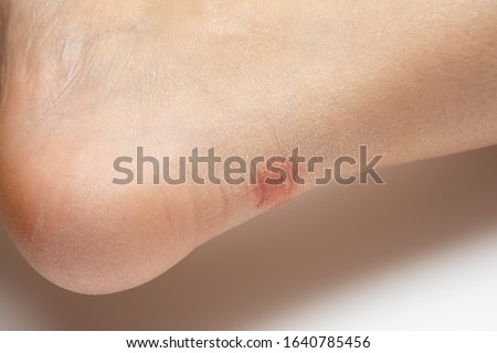 Broken and sore blister on the heel of a Caucasian lady. Problem due to inadequate footwear
